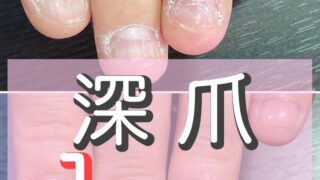 深爪　施術１回目の変化